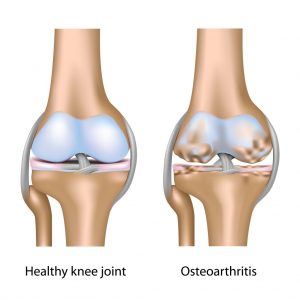 Osteoarthritis-of-Knee-Joint