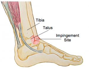 ankleimp