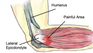 tennis elbow